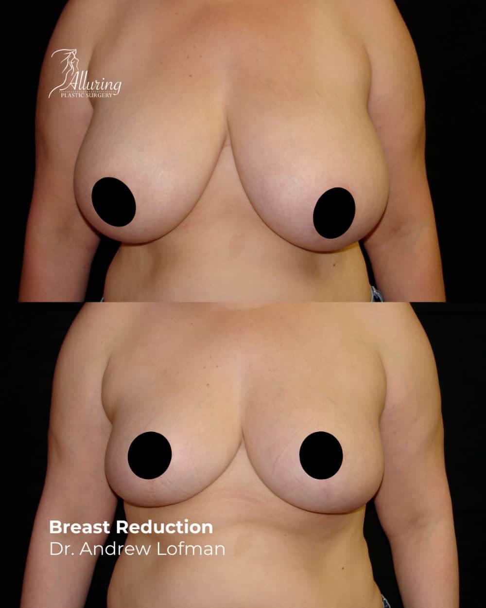 Side-by-side before and after images of a woman's upper torso showing breast reduction surgery results, with smaller, lifted, and more proportionate breasts in the after photo, photographed from the front against a black background.