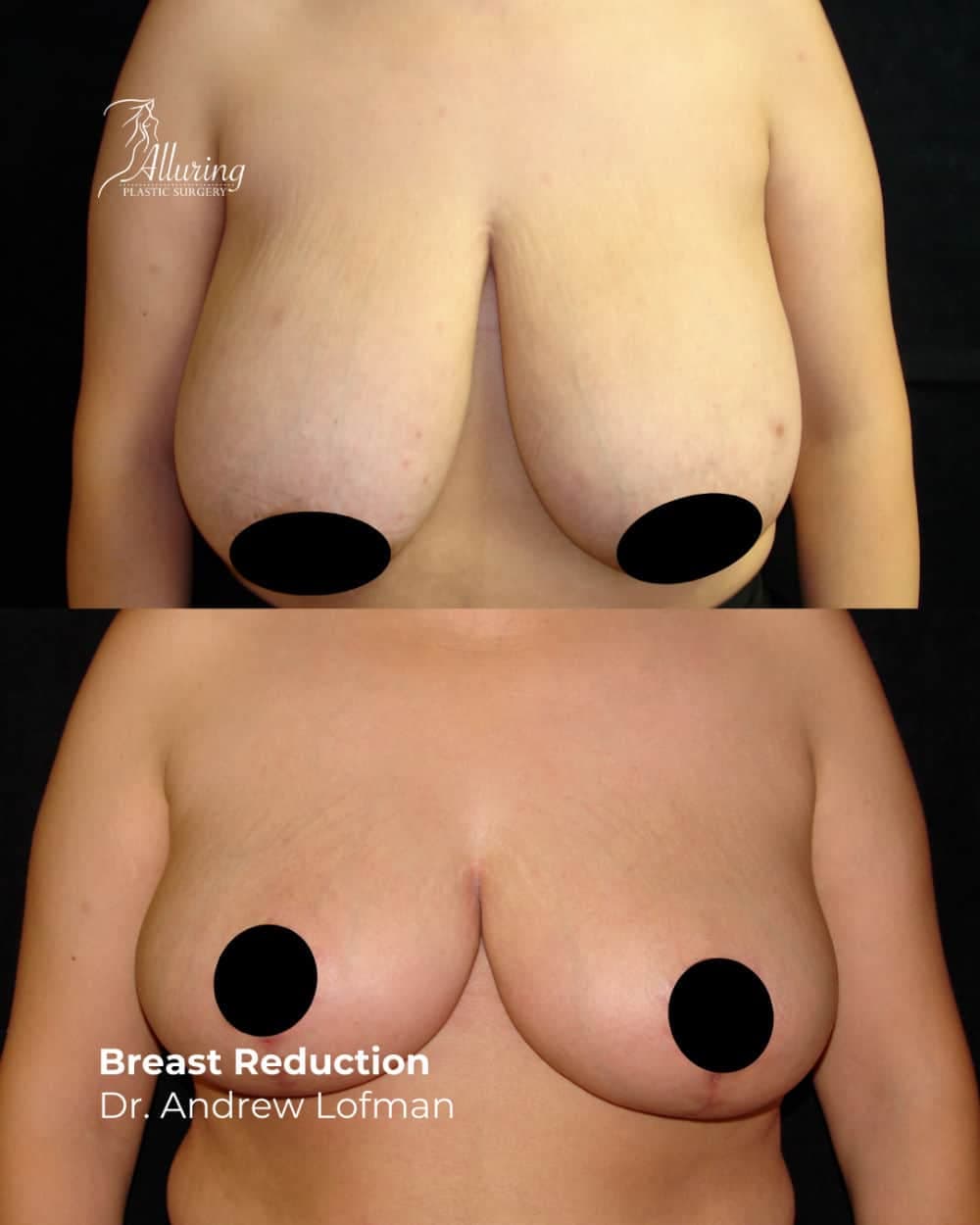 Side-by-side before and after images of a female patient's torso showing breast reduction results, with reduced size, lifted breast shape, and improved nipple position. Areolas are censored for privacy.