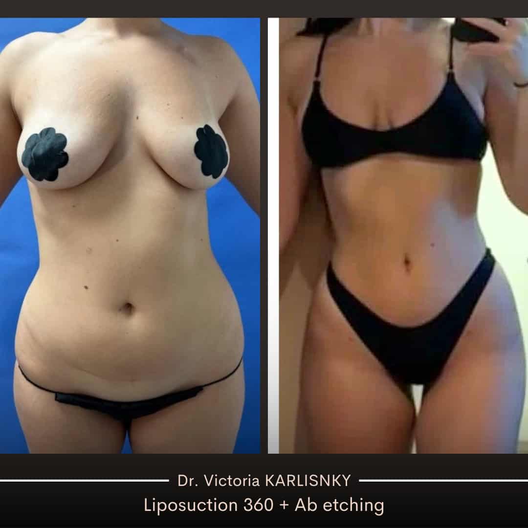Side-by-side before and after photos of a woman’s torso showing liposuction and abdominal etching results, with improved waistline and muscle definition.