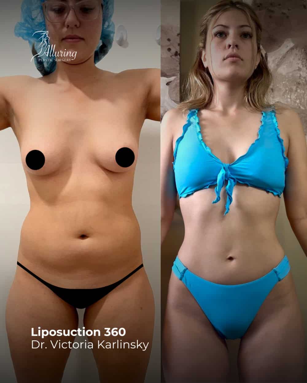 Side-by-side before and after photos of a woman showing Lipo 360 results, with a slimmer waist and more defined abdominal contours, front view
