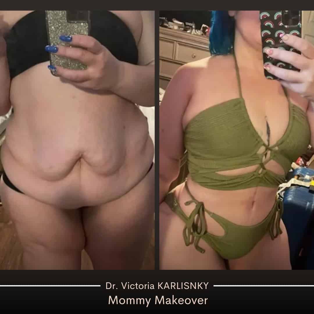 Side-by-side before and after images showing a woman's torso transformation following a mommy makeover, featuring a flatter abdomen, tighter skin, and enhanced waistline.