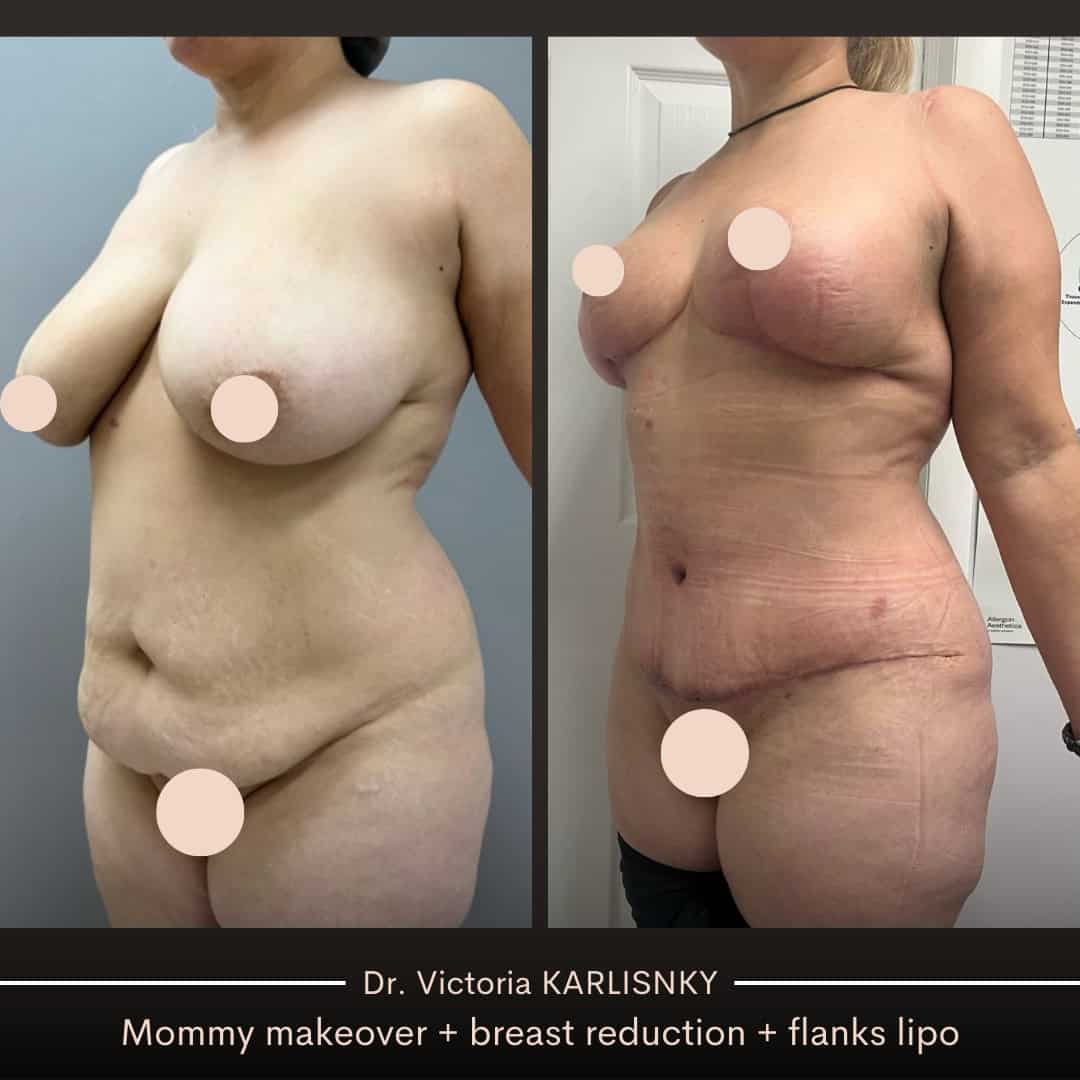 Side-by-side before and after images of a woman following a mommy makeover, showing improved breast position, a flatter abdomen, and enhanced waist definition from an oblique view.