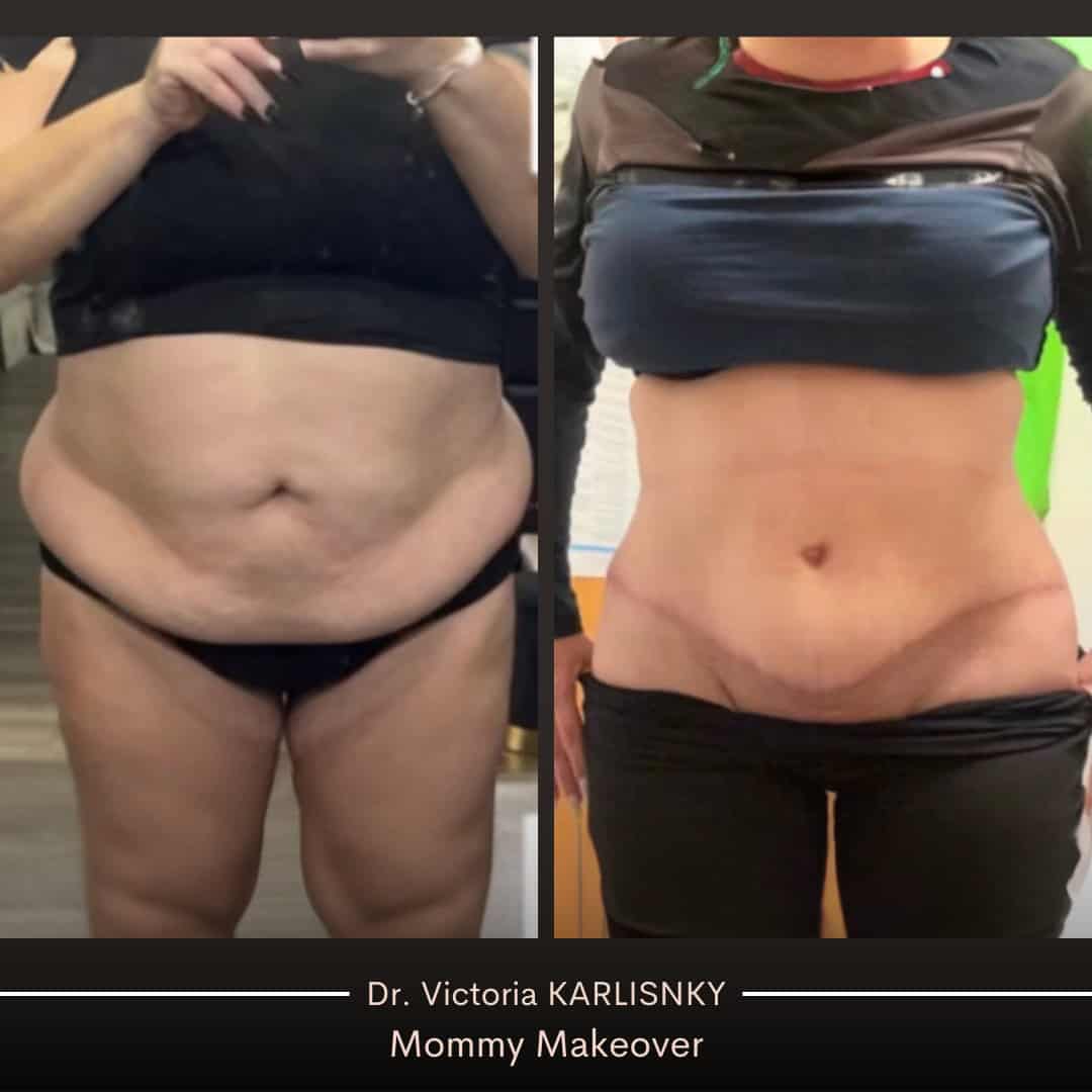 Side-by-side before and after images of a female patient's abdomen showing significant improvement in contour and flatness after a mommy makeover with tummy tuck; faint surgical scar visible, front view.