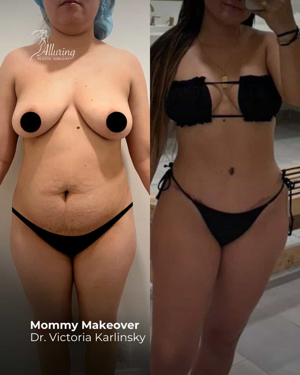 Side-by-side before and after images of a female patient showing mommy makeover results with improved breast contour and a flatter, toned abdomen, front view