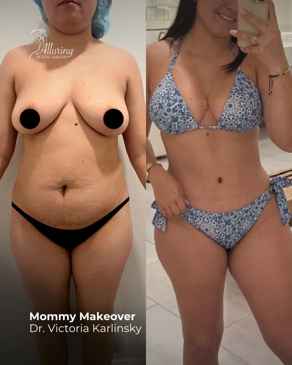 Side-by-side before and after images of a woman showing results from a mommy makeover, with lifted breasts and a flatter, more contoured abdomen in the post-operative bikini photo.