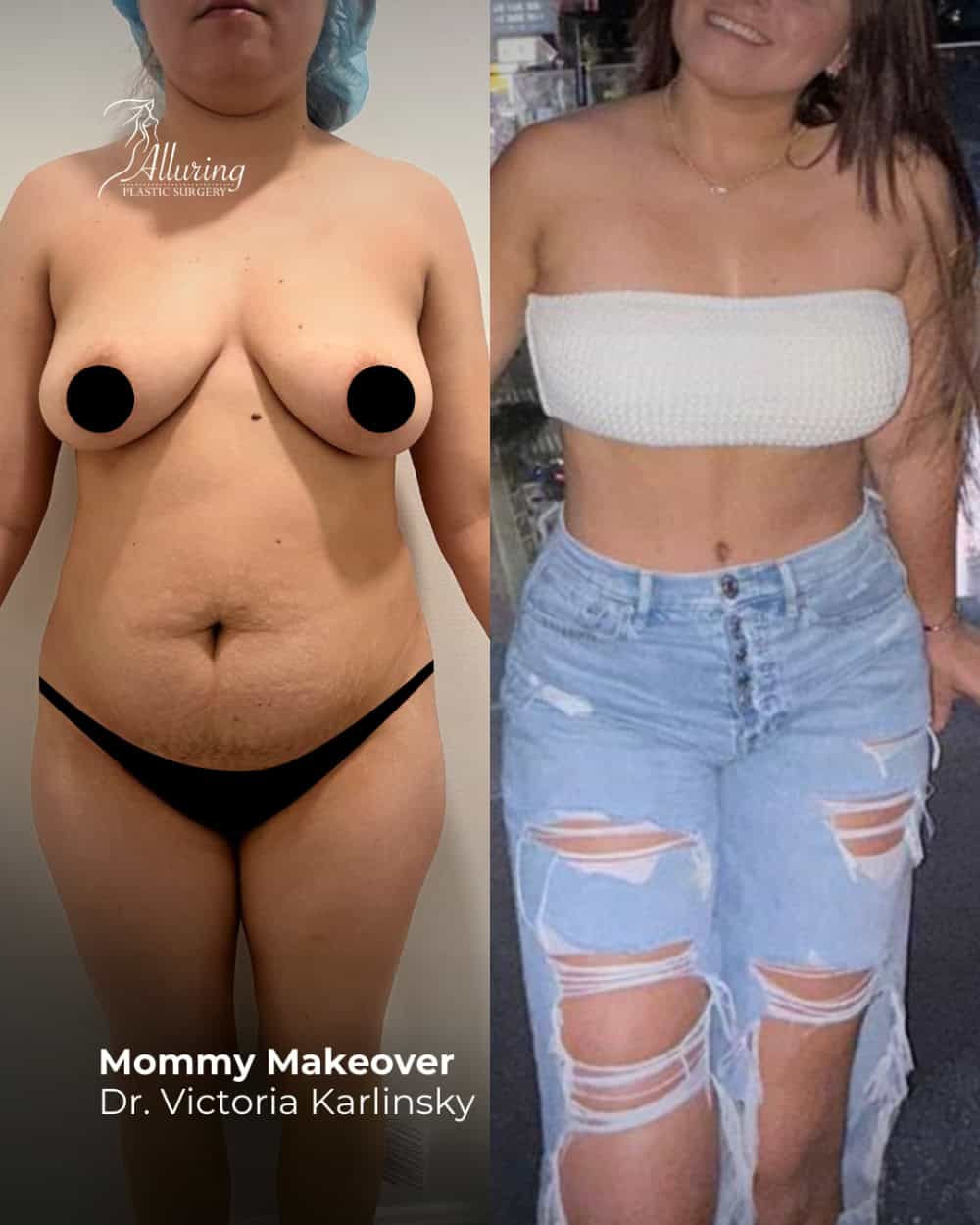 Side-by-side before and after images of a woman undergoing a mommy makeover, showing a pre-operative clinical photo with breast ptosis and abdominal laxity, and a post-operative lifestyle photo revealing a flatter abdomen, lifted breasts, and a more contoured waistline.