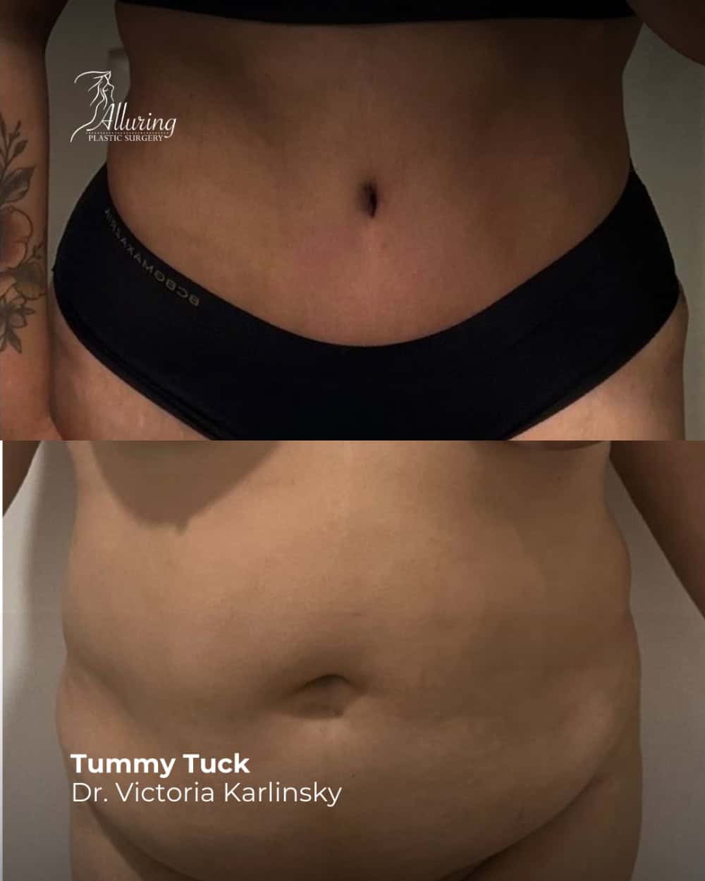 Before and after tummy tuck results showing a woman’s midsection with improved abdominal contour, tighter skin, and reduced excess tissue, front view
