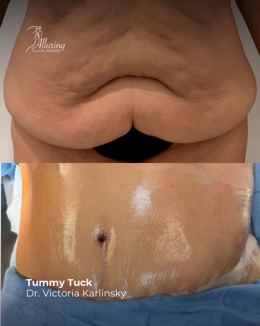 Side-by-side before and after images of a tummy tuck showing the lower abdomen with loose skin pre-surgery and a smooth, tightened abdomen post-surgery with a healing incision around the navel.