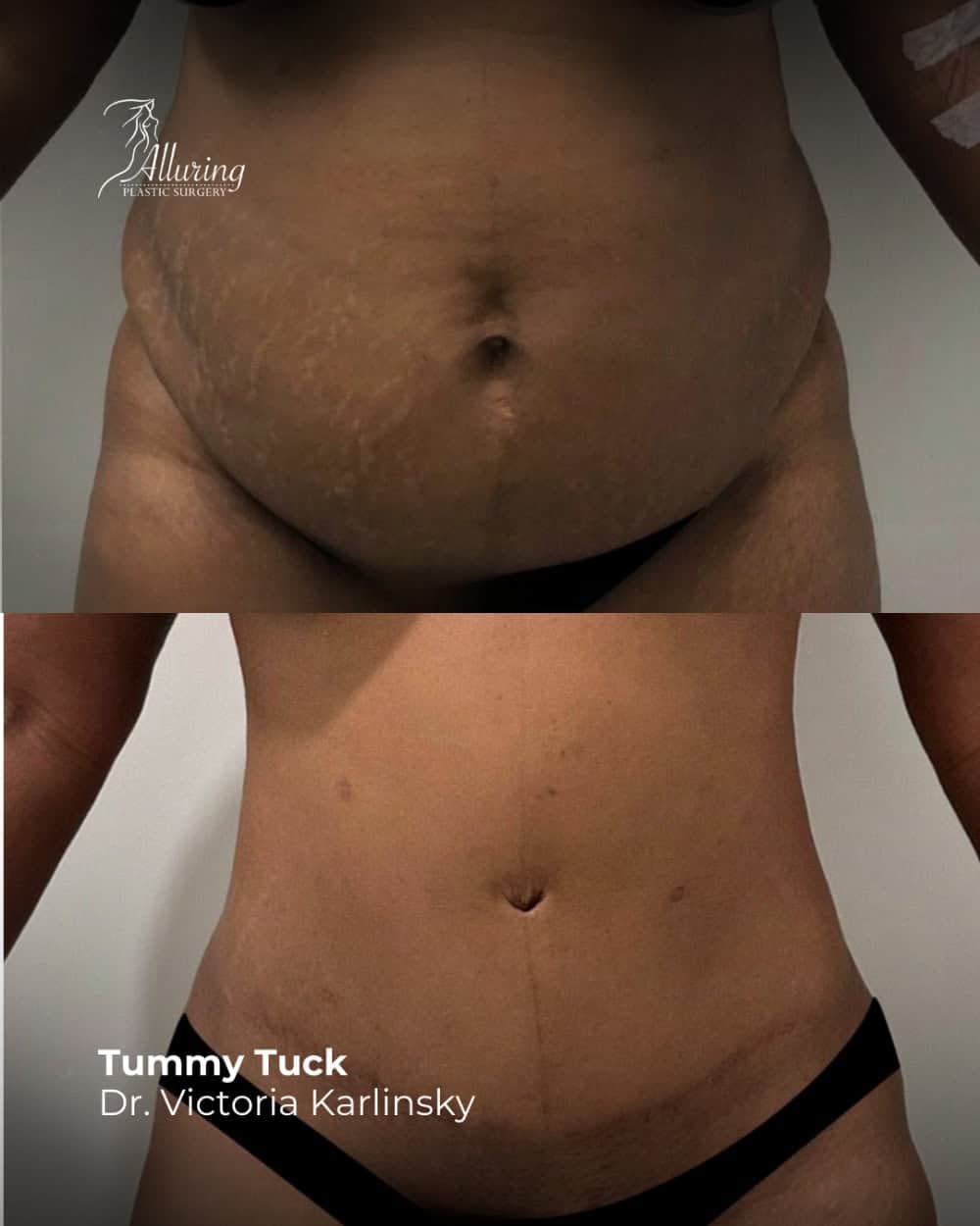 Side-by-side before and after images of a woman's torso showing tummy tuck results; the after photo reveals a flatter, smoother abdomen with improved skin tightness and waist definition.