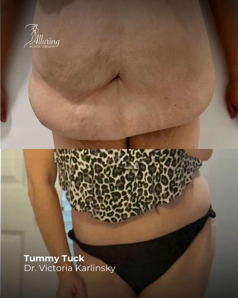 Side-by-side before and after photos of a female patient's abdomen showing tummy tuck results with reduced excess skin and improved contour, patient in a leopard print top and black underwear
