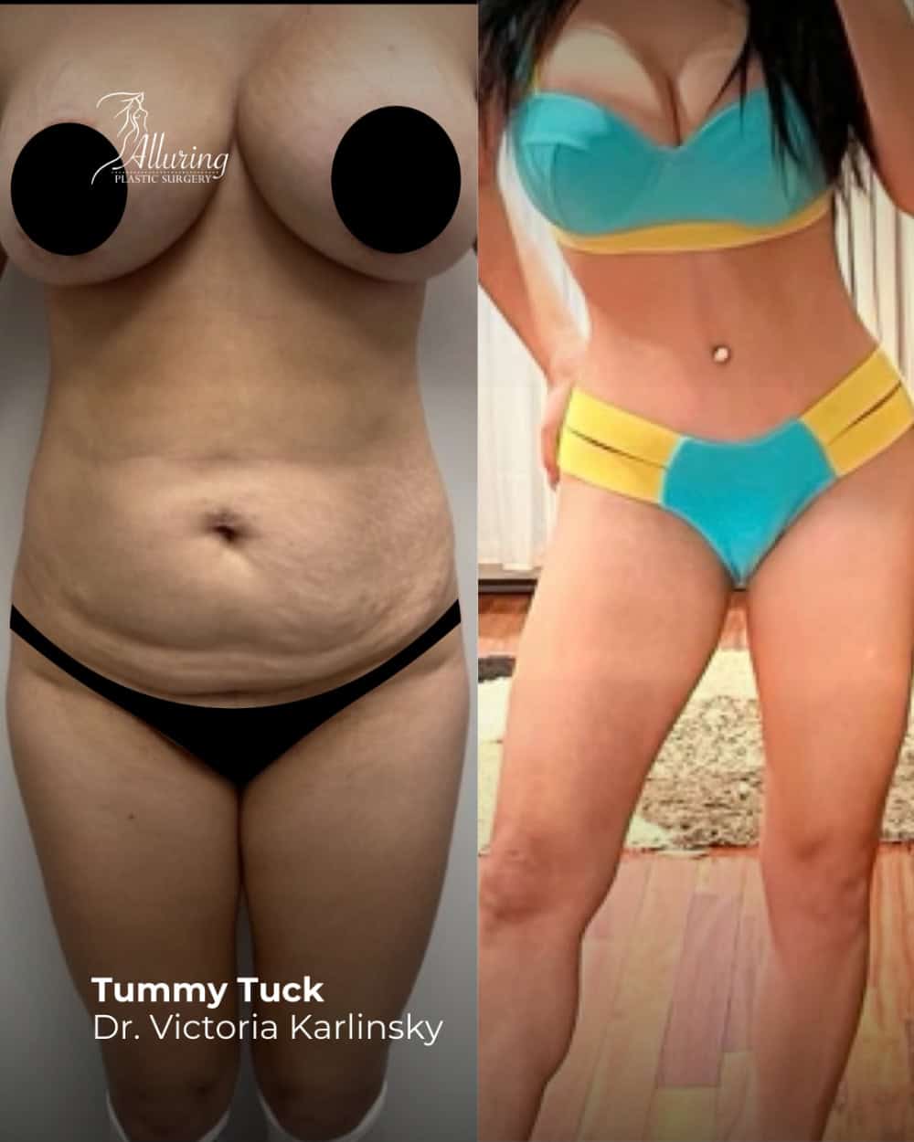 Side-by-side before and after images of a female patient showing a flatter, more contoured abdomen following a tummy tuck, with improved skin tone and waist definition