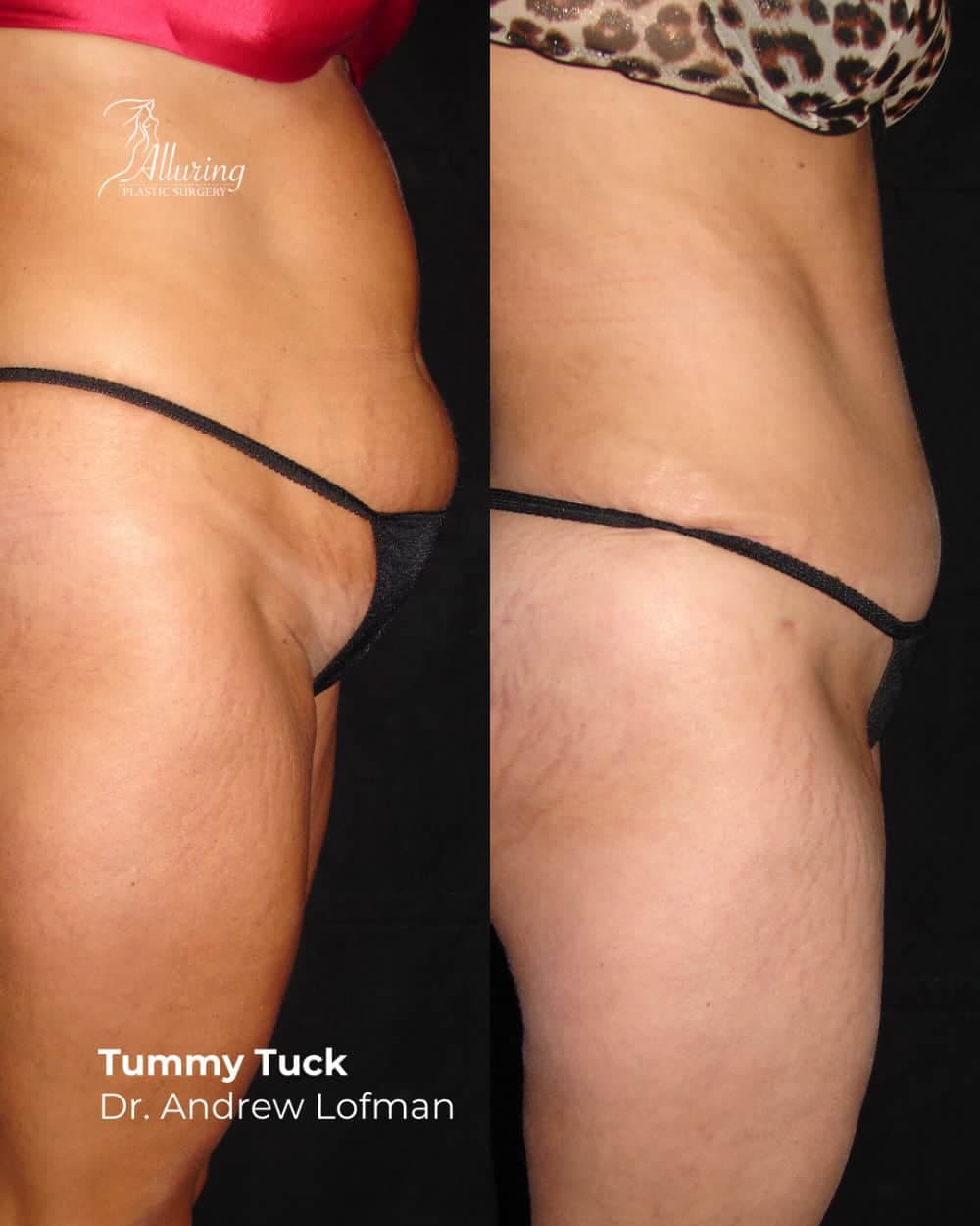 Side-by-side before and after images of a woman’s abdomen, showing improved contour, tighter skin, and a flatter tummy after a tummy tuck procedure, photographed from the side.