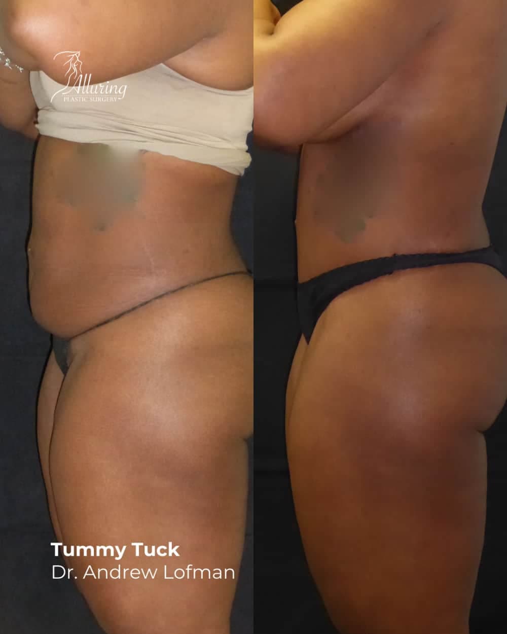 Side-by-side before and after tummy tuck results, profile view of female torso showing a flatter, more defined abdomen and waistline