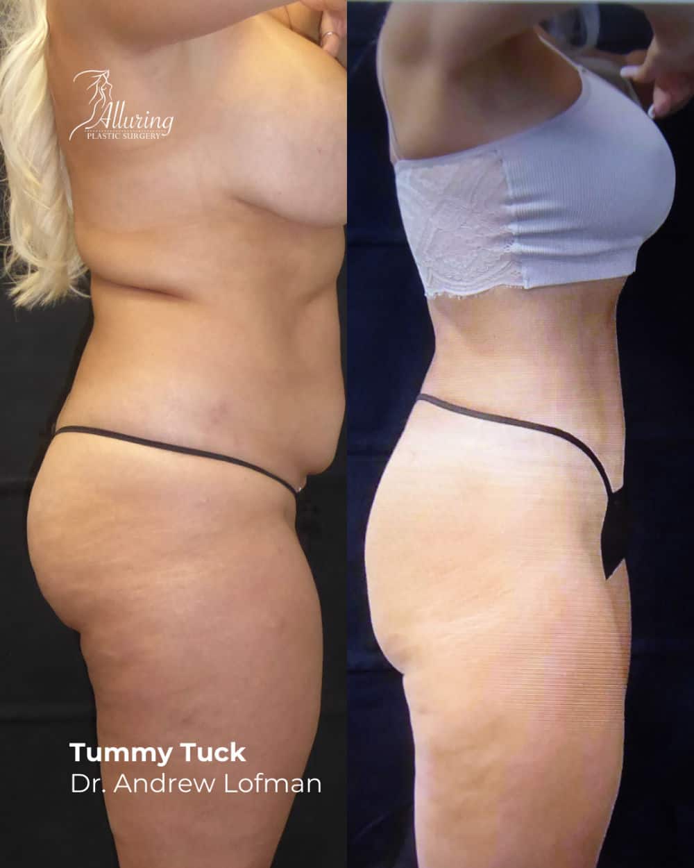 Side-by-side before and after images of a woman's tummy tuck, showing a flatter, smoother abdomen and improved waistline contour from a lateral view