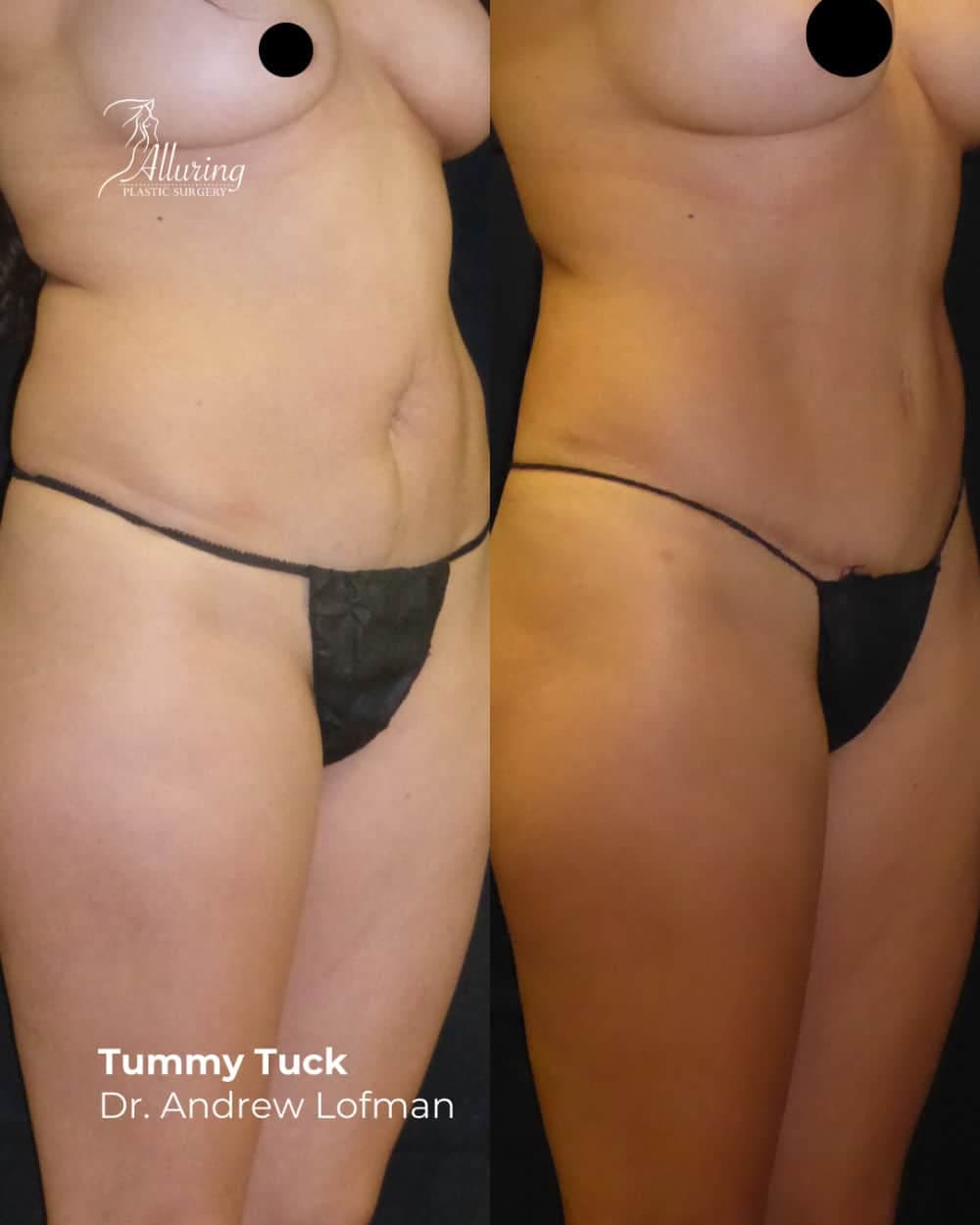 Side-by-side before and after images showing a female torso with improved abdominal contour, flatness, and skin tightness following a tummy tuck procedure