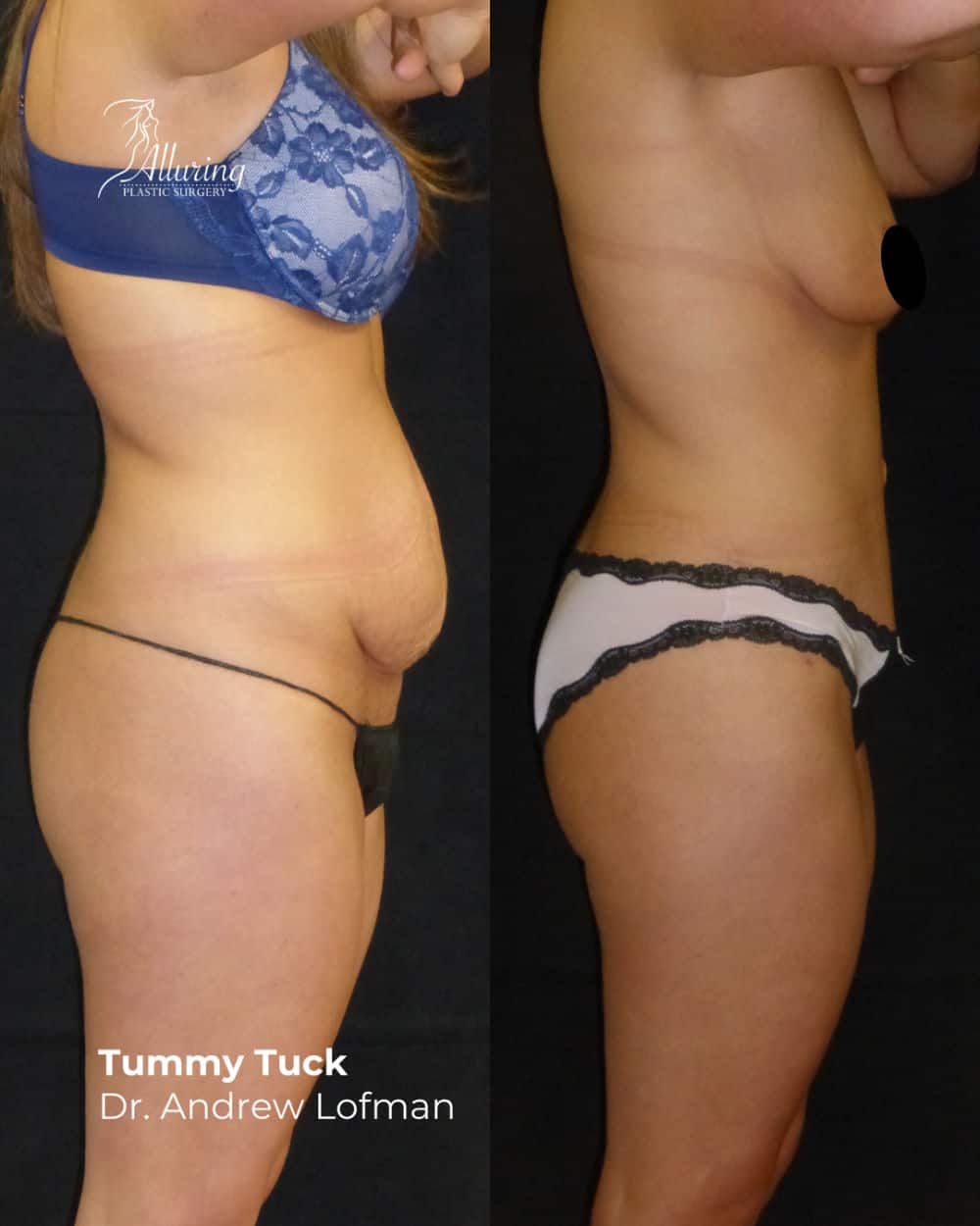 Side-by-side before and after images showing a woman's profile following a tummy tuck procedure, with a visibly flatter, tighter abdomen and smoother skin contour.