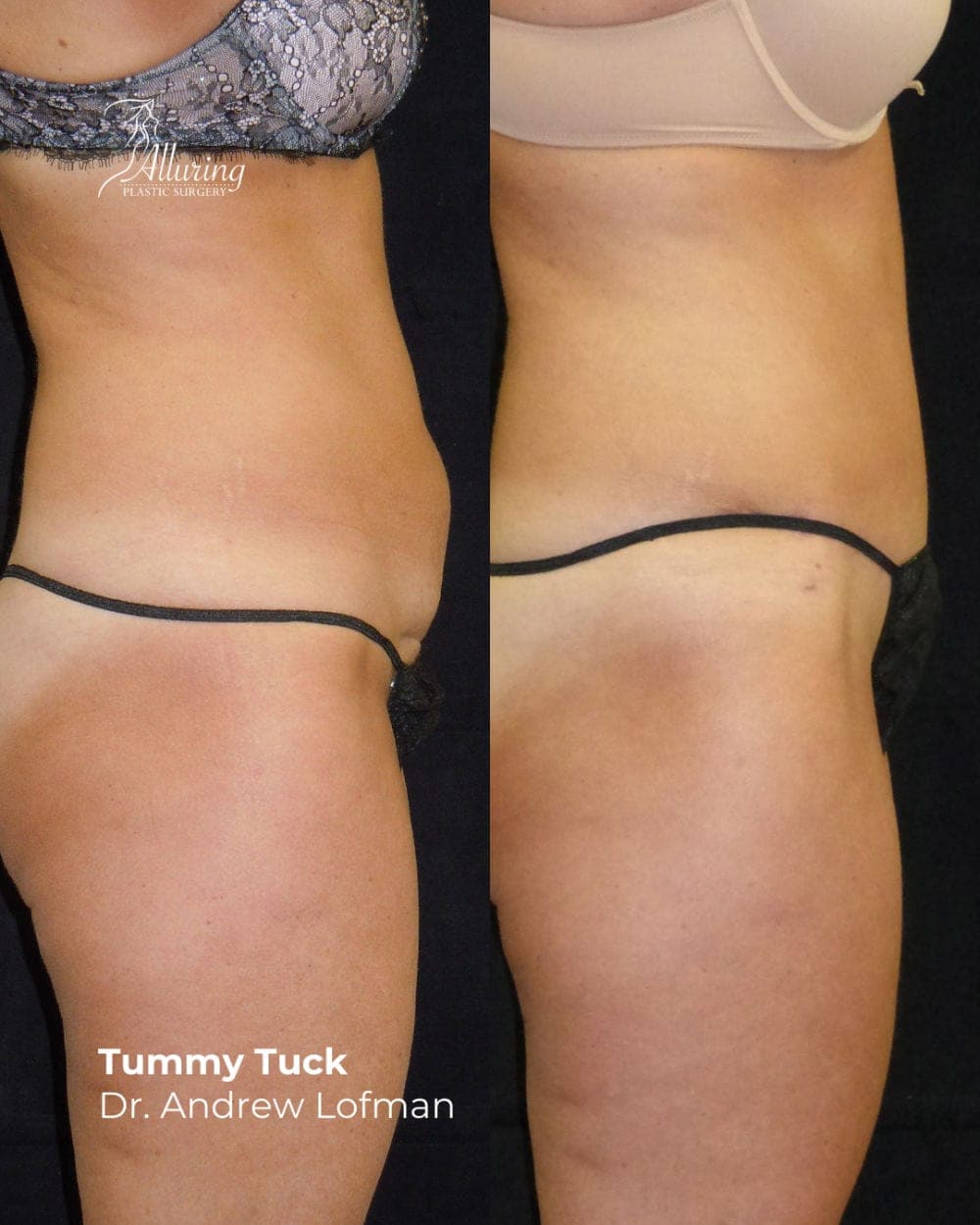 Side-by-side before and after images of a female torso showing tummy tuck results, with a visibly flatter, tighter abdomen and improved skin tone
