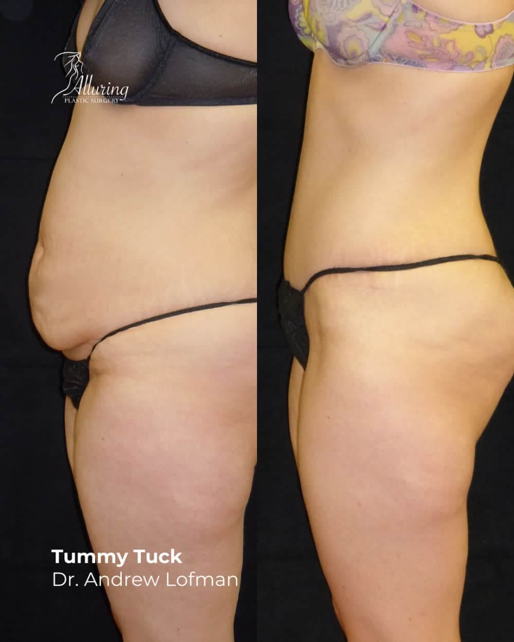 Side-by-side before and after tummy tuck results showing a female patient's flatter, more contoured abdomen and waistline, highlighting reduced abdominal laxity and smoother skin.
