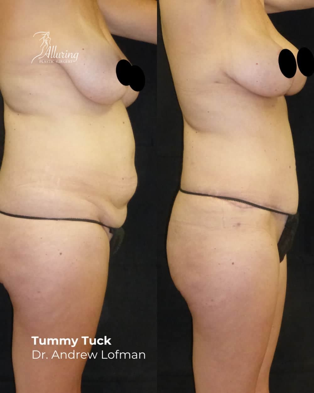 Side-by-side before and after images of a woman's torso and upper thigh area showing a flatter, more contoured abdomen and improved skin tightness following a tummy tuck procedure, with nipples censored for privacy.