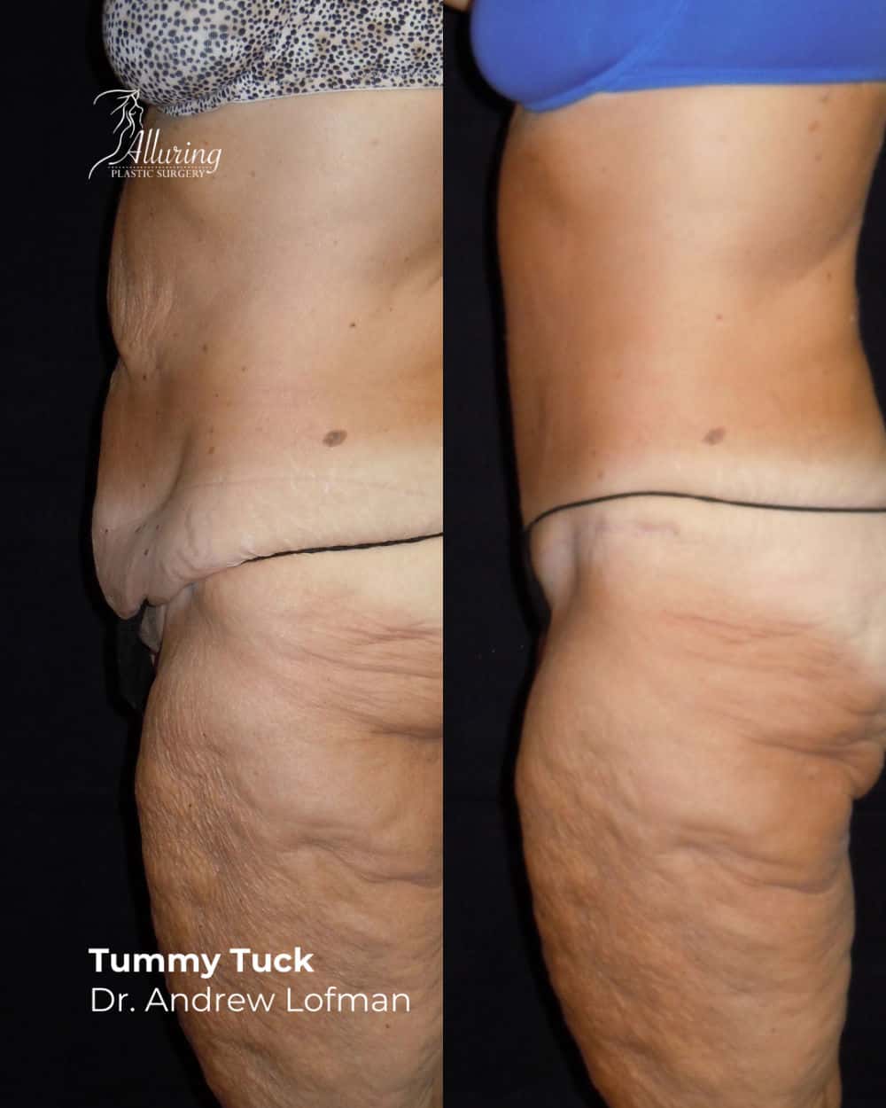 Side-by-side before and after images showing a woman's tummy tuck results, with a noticeably flatter and smoother abdomen and improved skin tightness, viewed in profile.