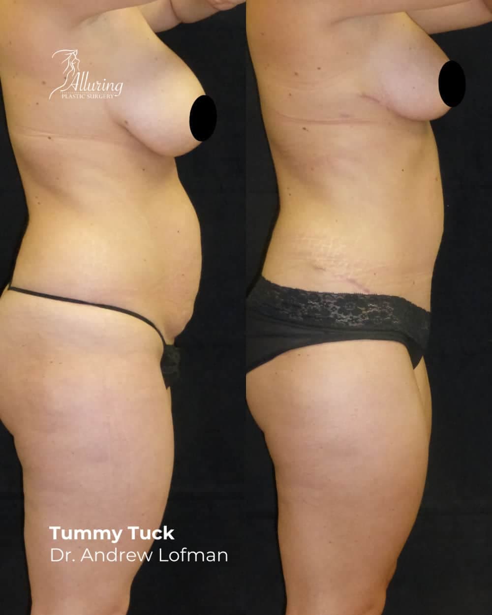 Side-by-side before and after images of a woman’s midsection following a tummy tuck, showing a flatter abdomen and smoother skin from a left lateral view