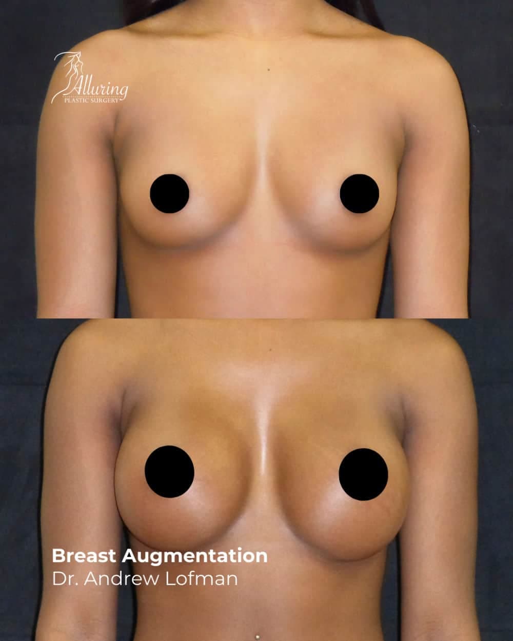 Side-by-side before and after images of a woman's upper torso showing breast augmentation results with increased volume and natural contour, photographed from the front with arms relaxed.