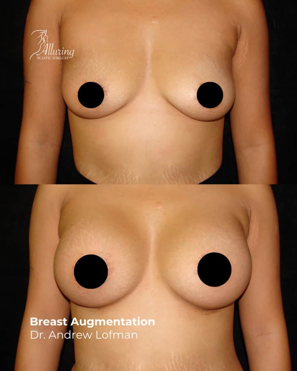 Frontal before and after comparison of a female patient's breast augmentation, showing increased volume, improved contour, and natural-looking results with censored nipples.