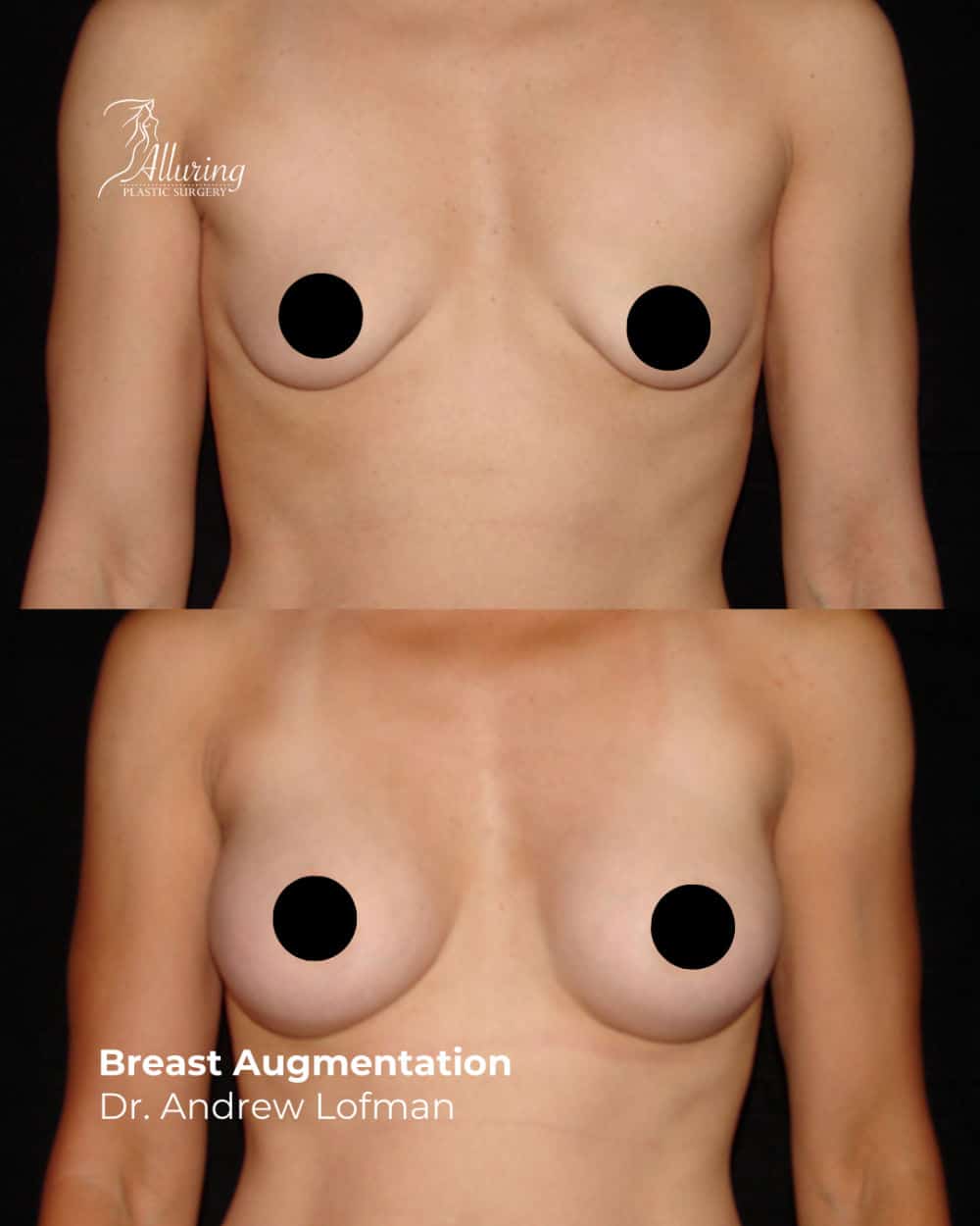 Side-by-side before and after photos of a woman's upper torso showing enhanced breast volume, improved symmetry, and natural contour following breast augmentation, frontal view.