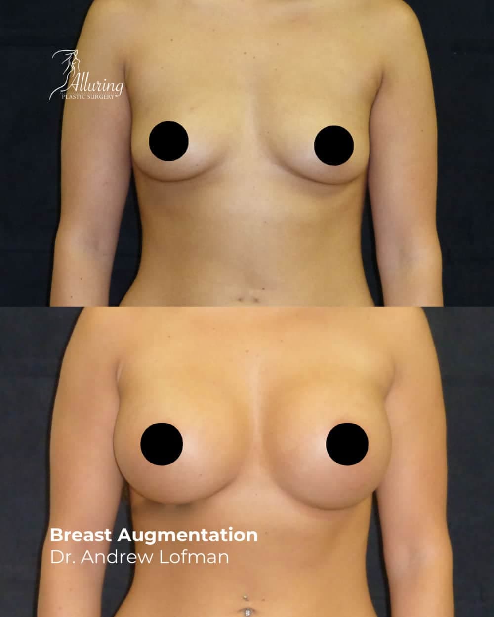 Side-by-side before and after images of a woman's chest showing enhanced breast volume and shape following breast augmentation, front view, with nipples censored for privacy.