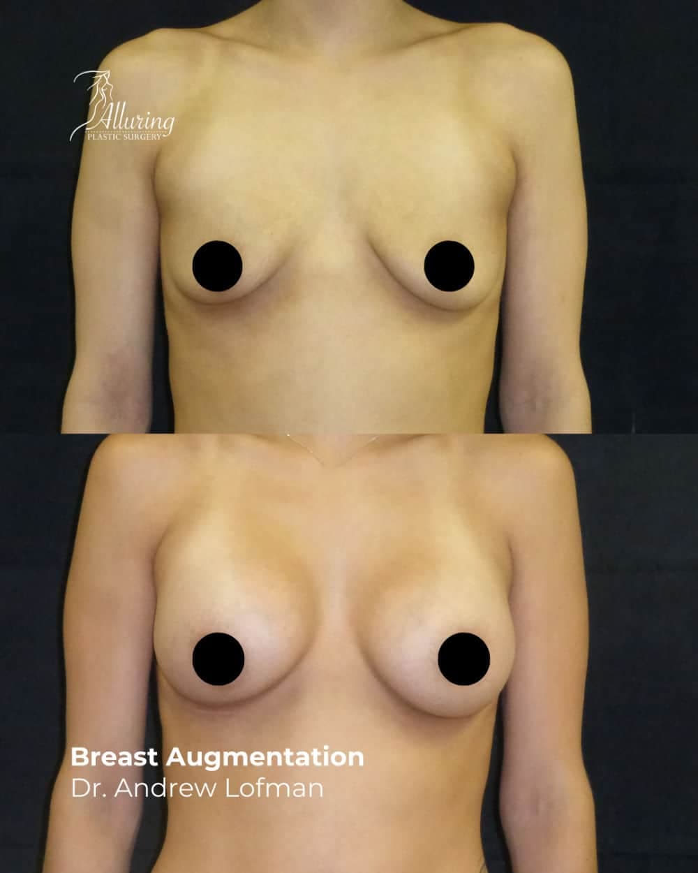 Side-by-side before and after images of a woman’s upper torso showing the results of breast augmentation, with increased breast size and fuller, rounded contours, front view.