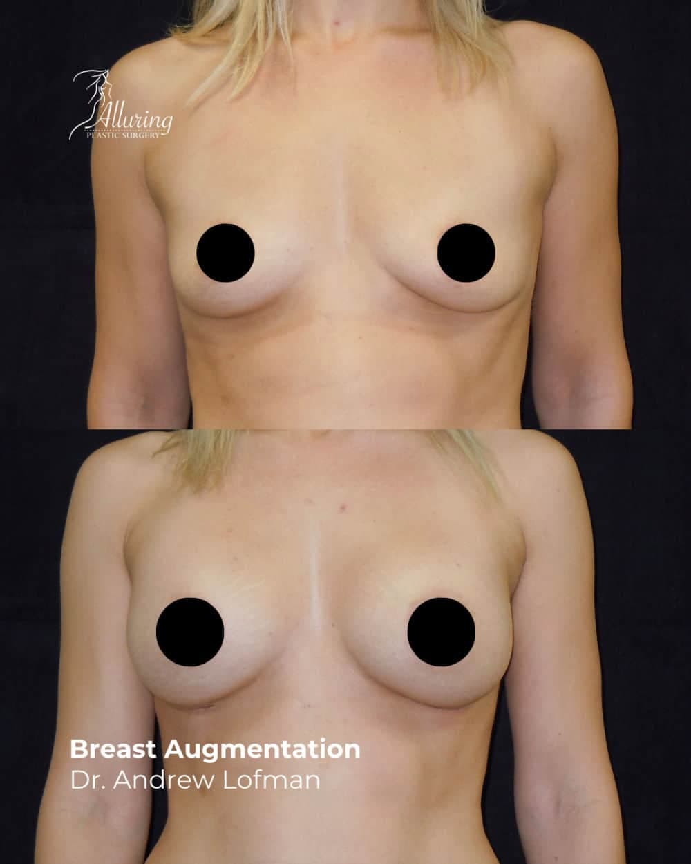 Side-by-side before and after photos of a woman’s breast augmentation, frontal view, showing increased breast volume and improved symmetry with a well-healed result.