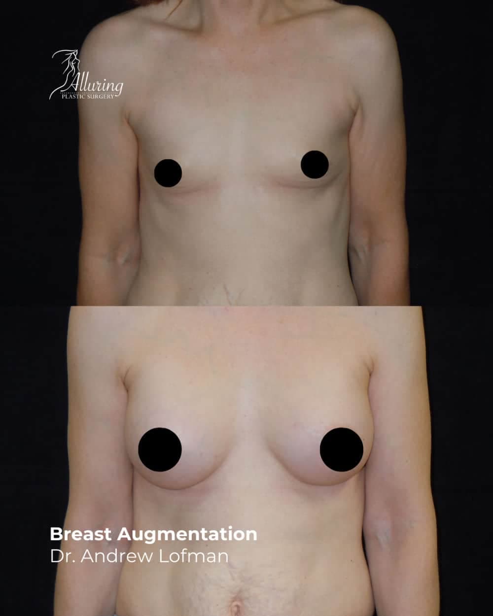 Frontal before and after comparison showing a female patient’s breast augmentation results, with increased volume and contour, nipples censored and arms relaxed at her sides