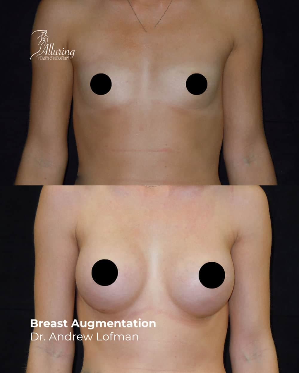 Before and after breast augmentation showing increased breast volume, improved shape, and natural symmetry, front view with nipples censored for privacy