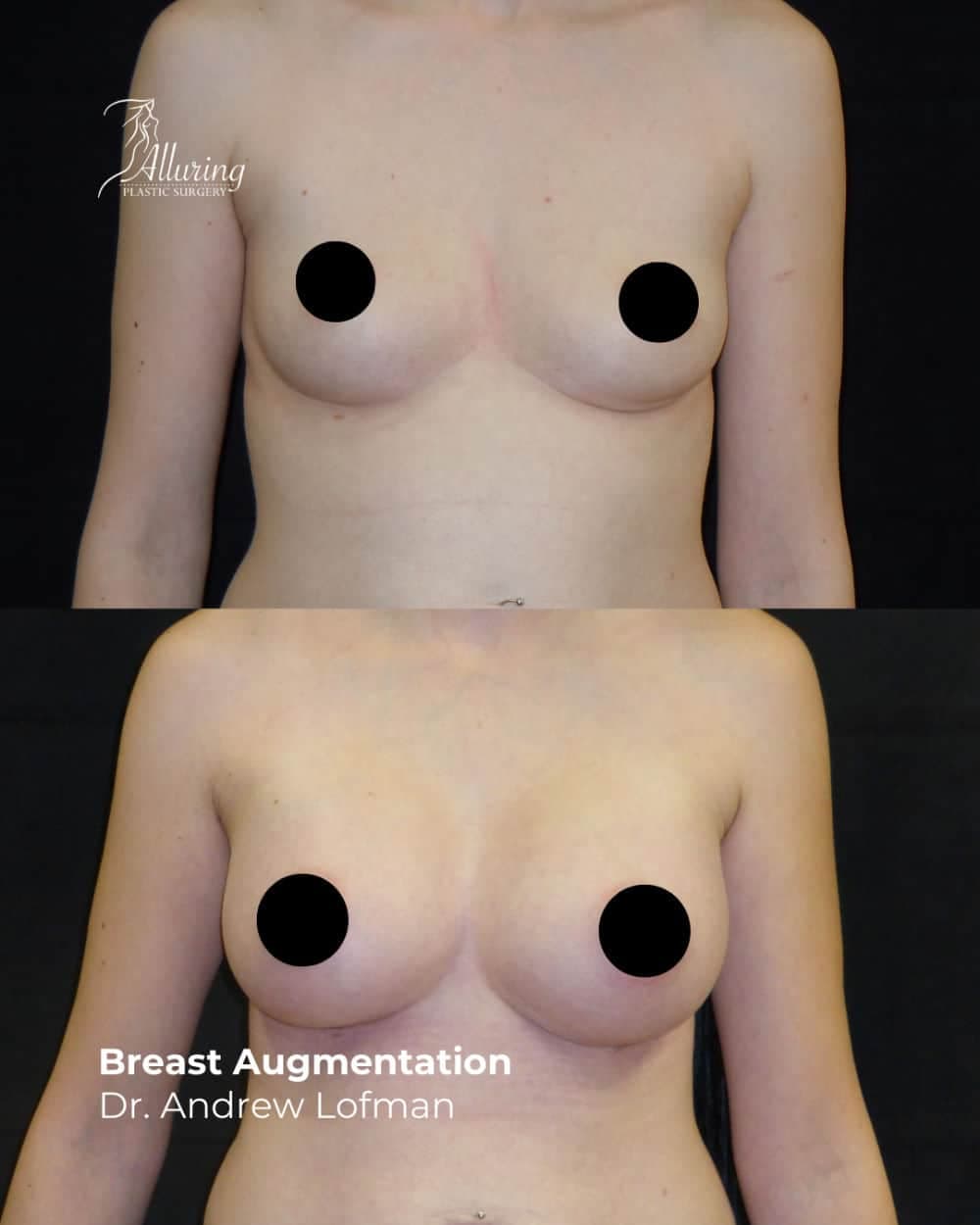 Side-by-side before and after images of a woman showing increased breast volume and improved projection following breast augmentation, frontal view on black background