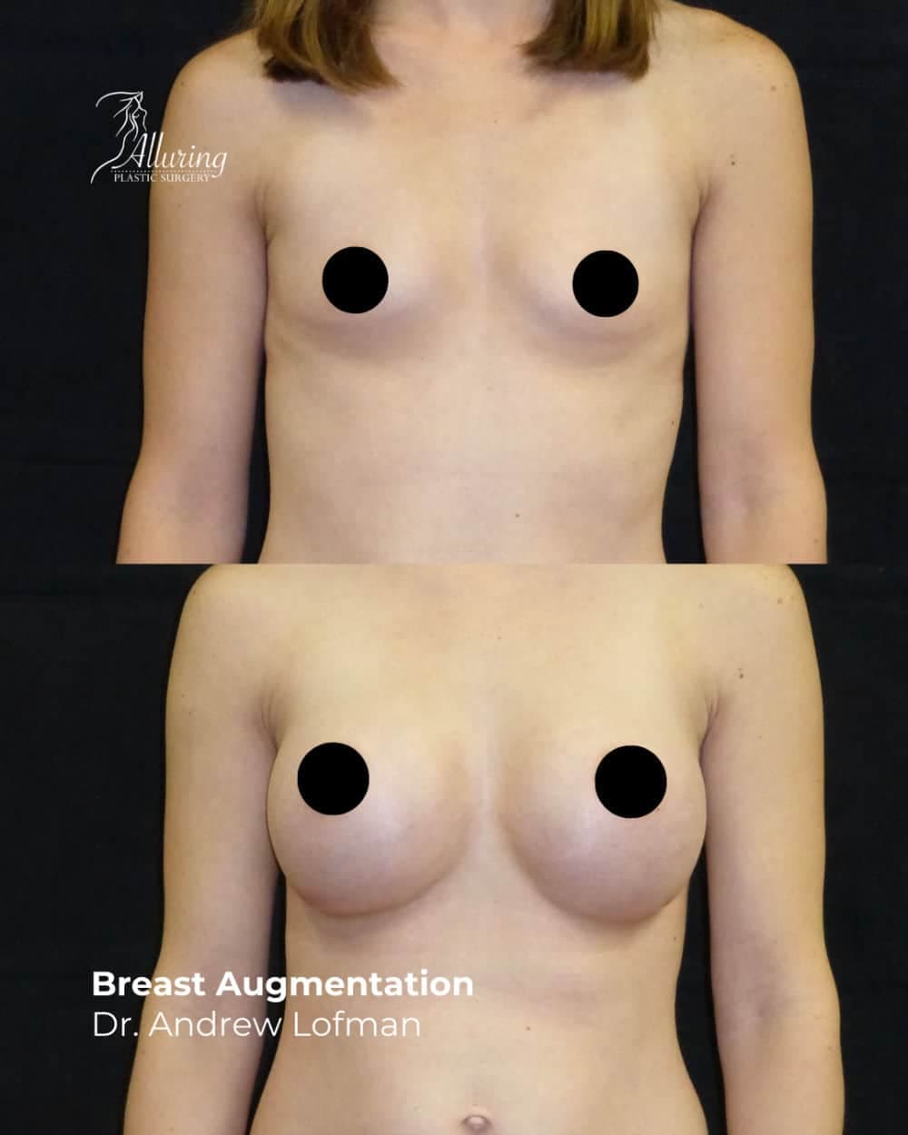 Before and after breast augmentation results, frontal view showing enhanced breast volume, improved contour, and natural symmetry