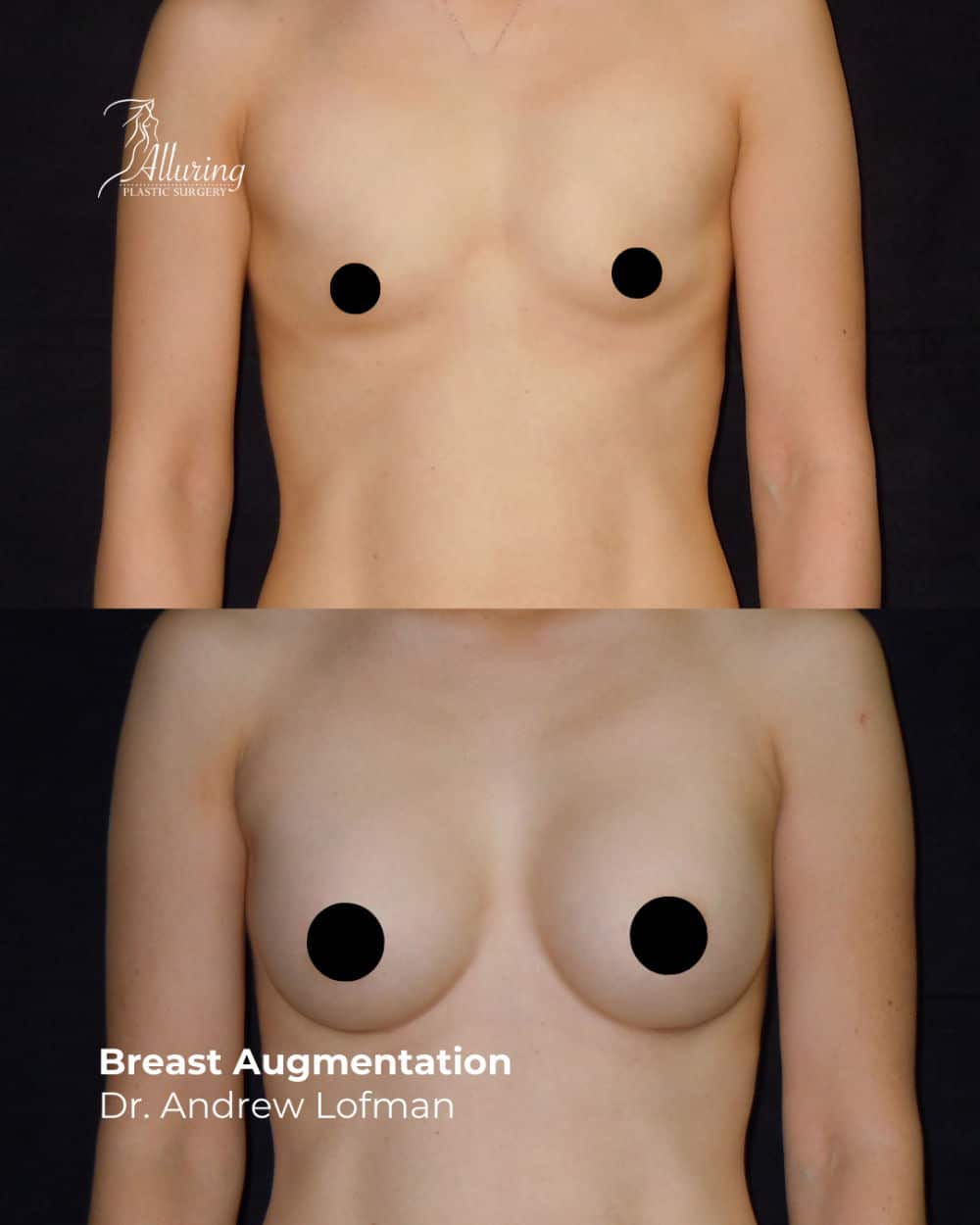 Side-by-side before and after images of a woman's chest showing increased breast volume and projection following breast augmentation, with natural-looking, symmetrical results.