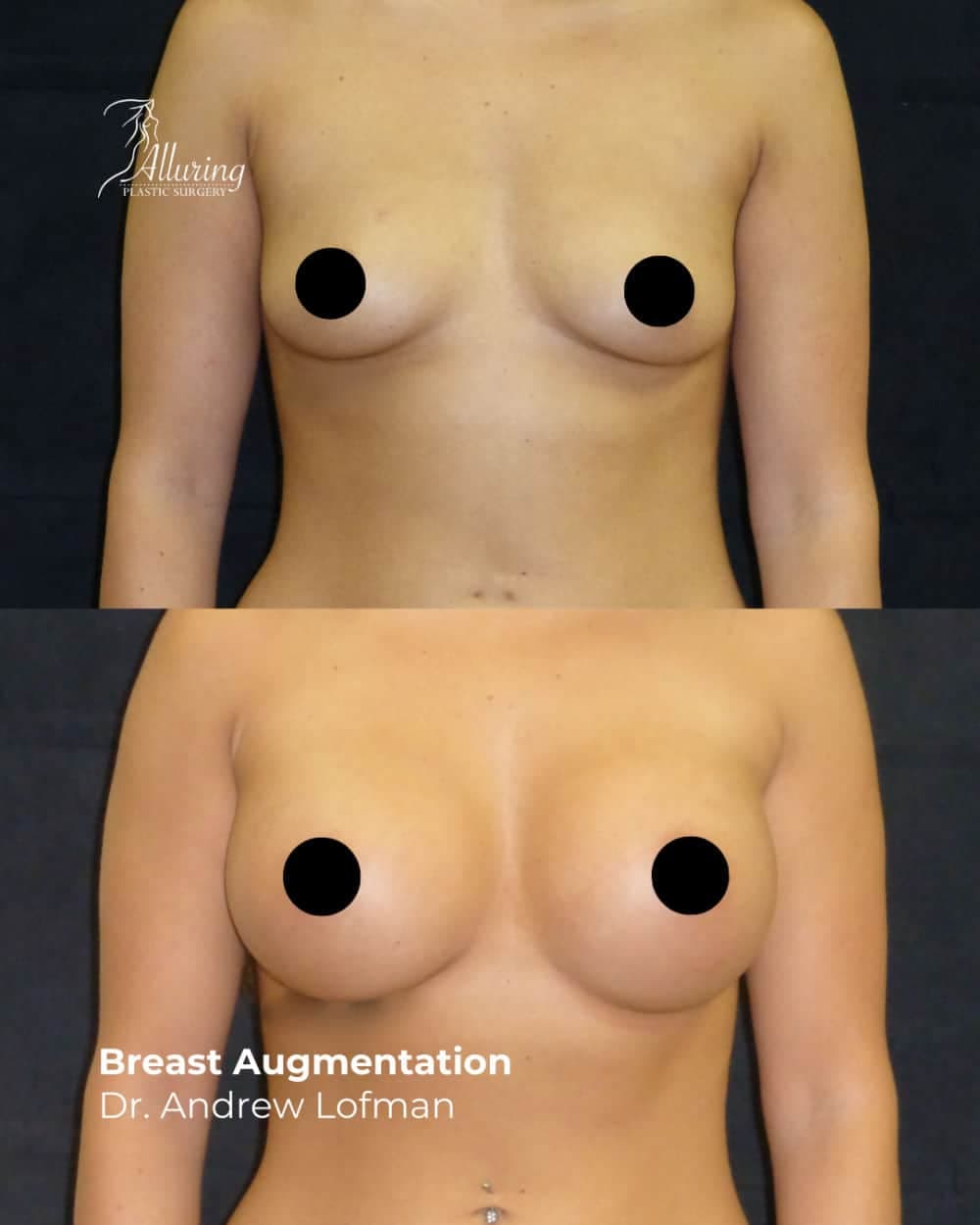 Side-by-side before and after images showing breast augmentation results on a woman’s upper torso, with increased fullness, projection, and symmetry visible in the after photo.