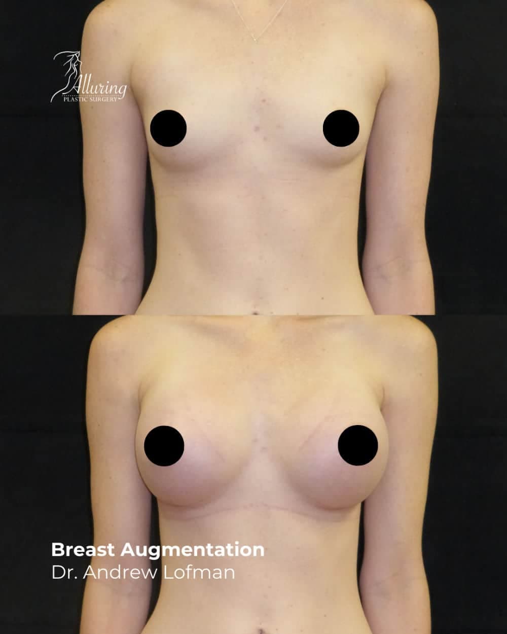 Frontal before and after images of a patient showing increased breast volume and improved shape following breast augmentation surgery, with nipples censored for privacy