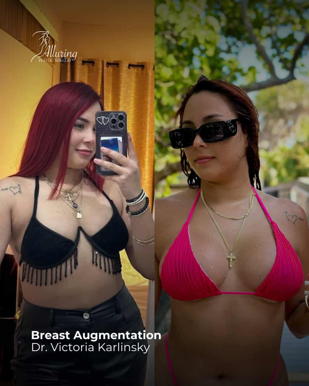 Side-by-side before and after images of a woman’s breast augmentation, showing increased volume and rounded breast shape in a pink bikini top