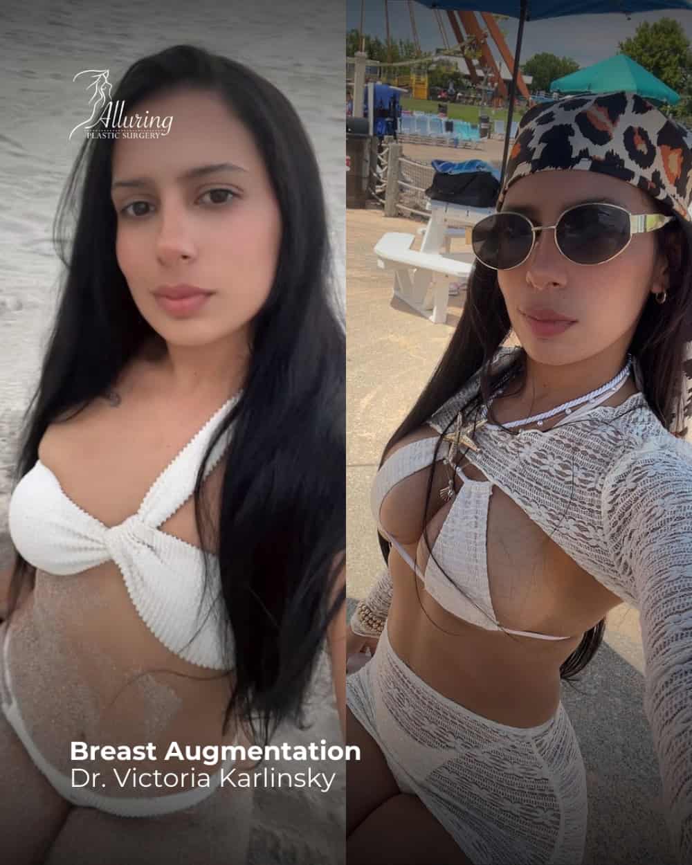 Side-by-side before and after images of a woman in a white bikini outdoors, highlighting enhanced breast volume and contour from breast augmentation