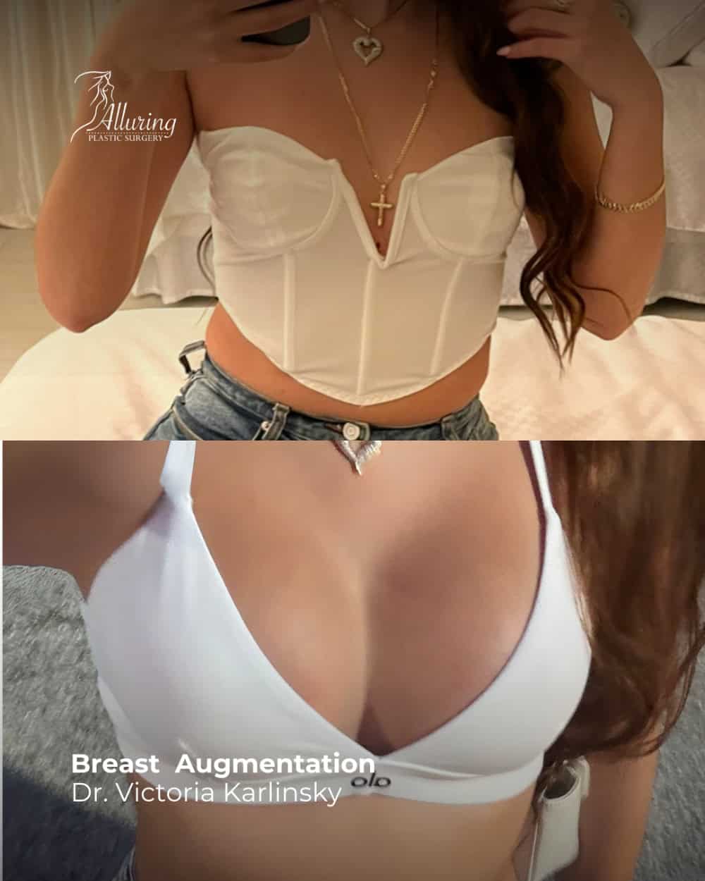 Side-by-side before and after images of a woman's upper torso, showing increased breast volume and enhanced shape following breast augmentation, with the patient wearing a white bustier in the before and a white bra in the after.