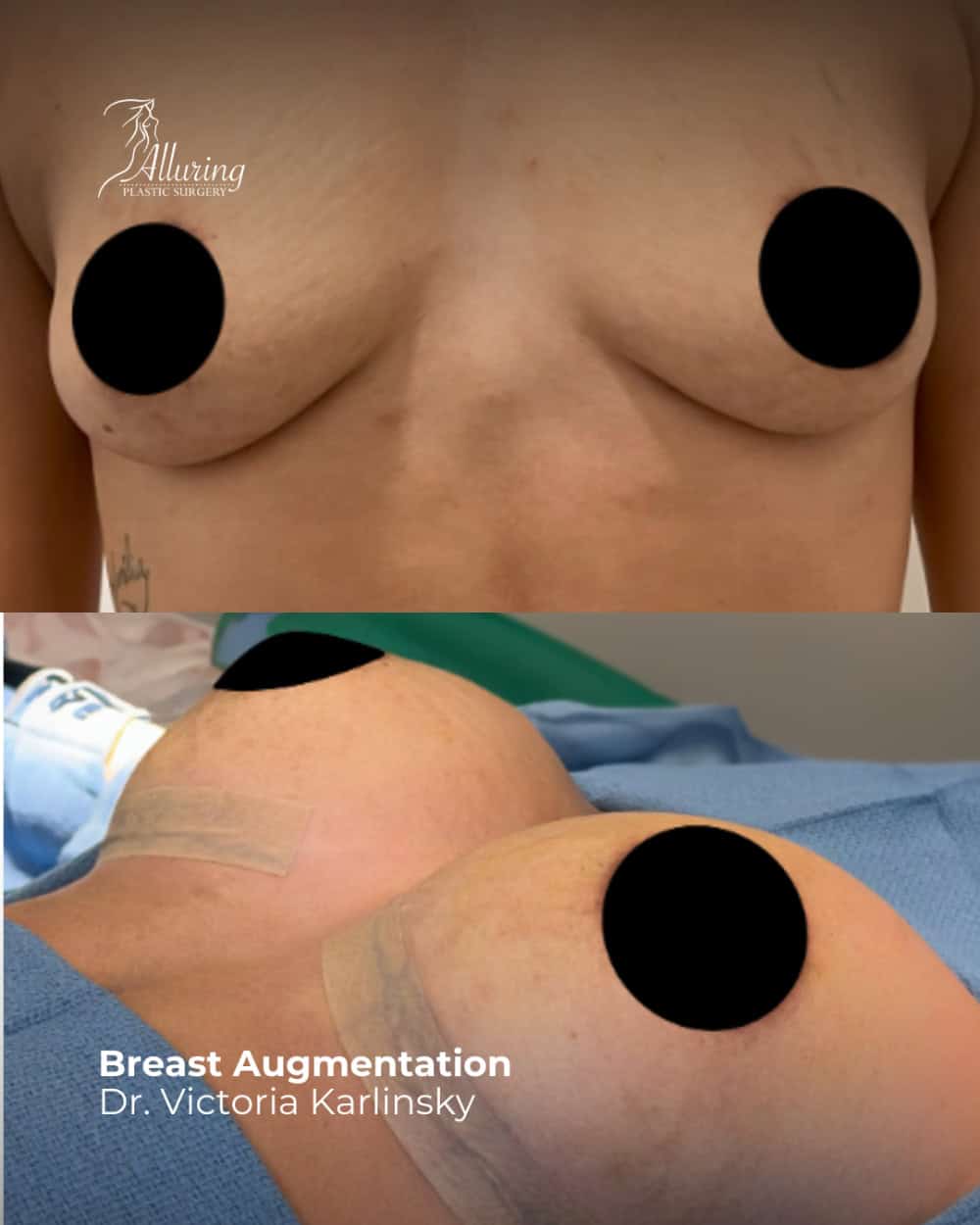Side-by-side before and after images of a female patient's breast augmentation, showing increased volume, improved symmetry, and surgical dressings on the post-operative result, with chest and upper torso in focus.