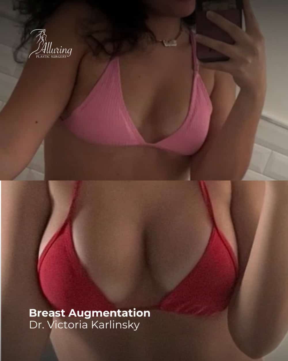 Side-by-side before and after images of a woman in a bikini top showing increased breast volume and improved contour following breast augmentation surgery