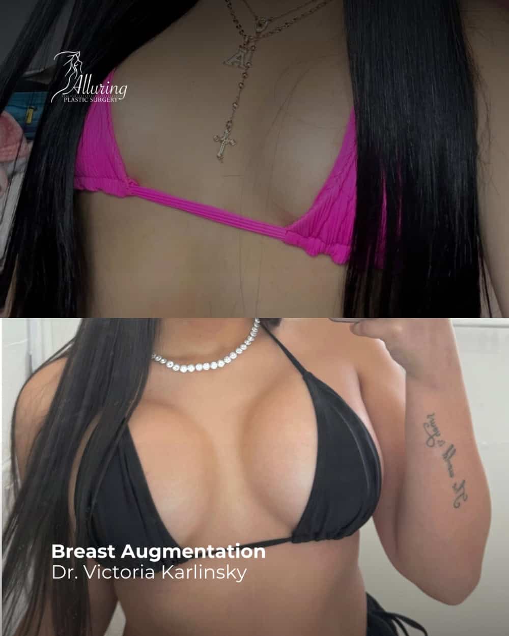 Side-by-side before and after breast augmentation photos showing increased breast volume, enhanced cleavage, and improved upper torso contour, with consistent lighting and positioning.