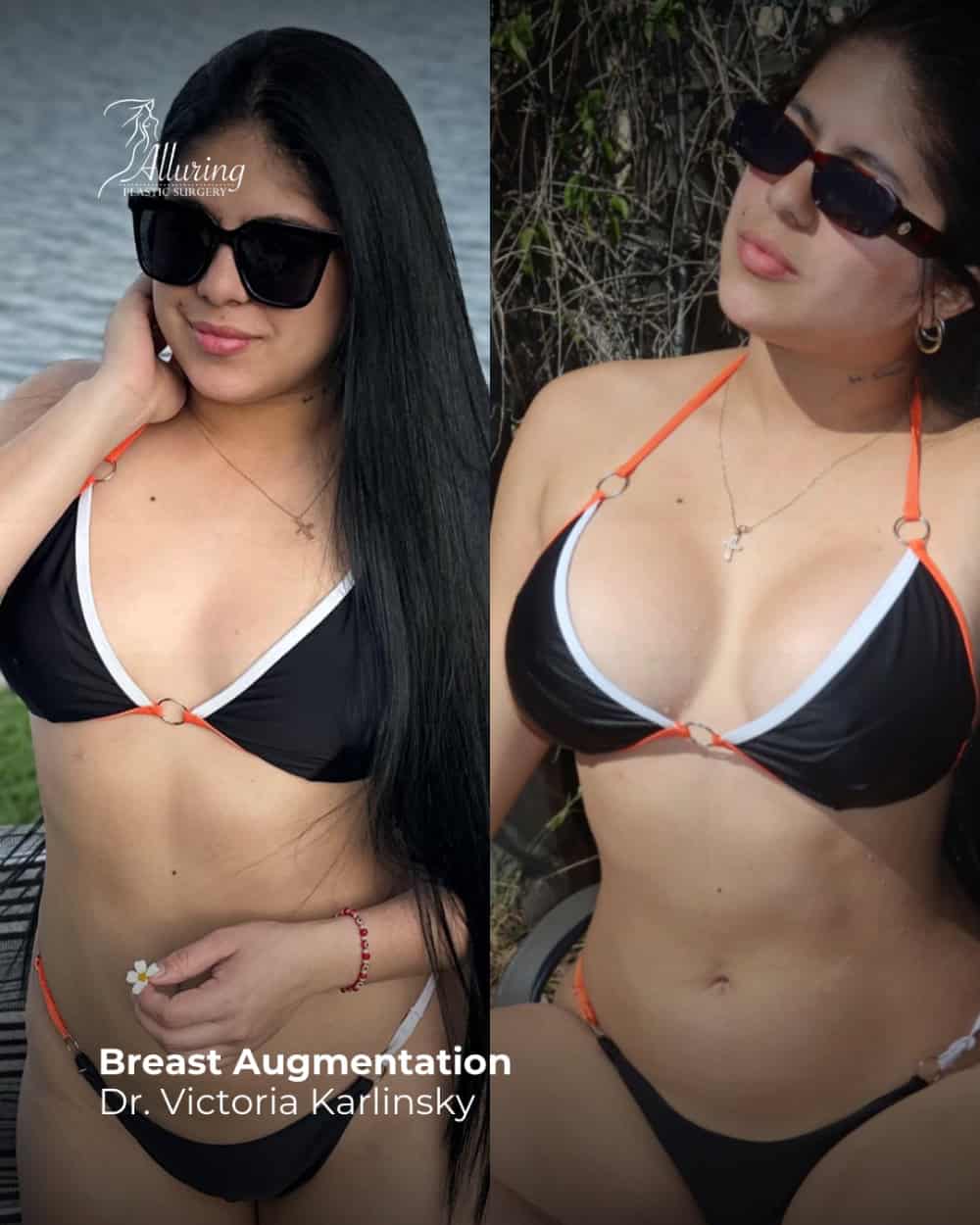 Side-by-side before and after breast augmentation results, showing a woman in a black and orange bikini outdoors with noticeably fuller, rounder breasts after surgery
