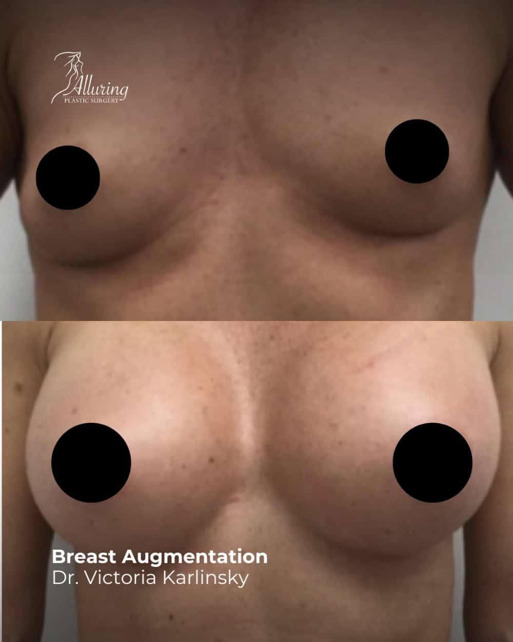 Side-by-side before and after images of a woman's chest showing fuller, symmetrical breasts following breast augmentation surgery, frontal view, nipples covered for privacy.