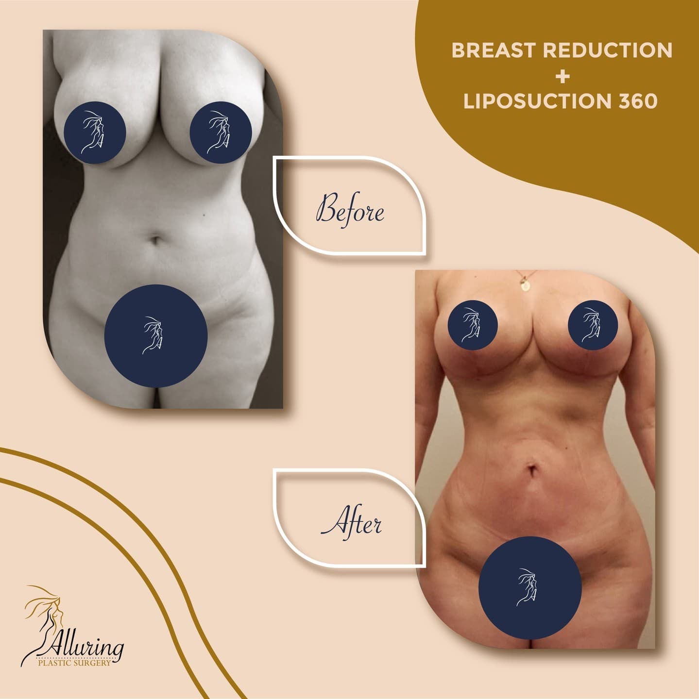 Before and after frontal images showing breast reduction and 360-degree liposuction results with reduced breast size, slimmer waist, and enhanced abdominal contour, with sensitive areas discreetly covered.
