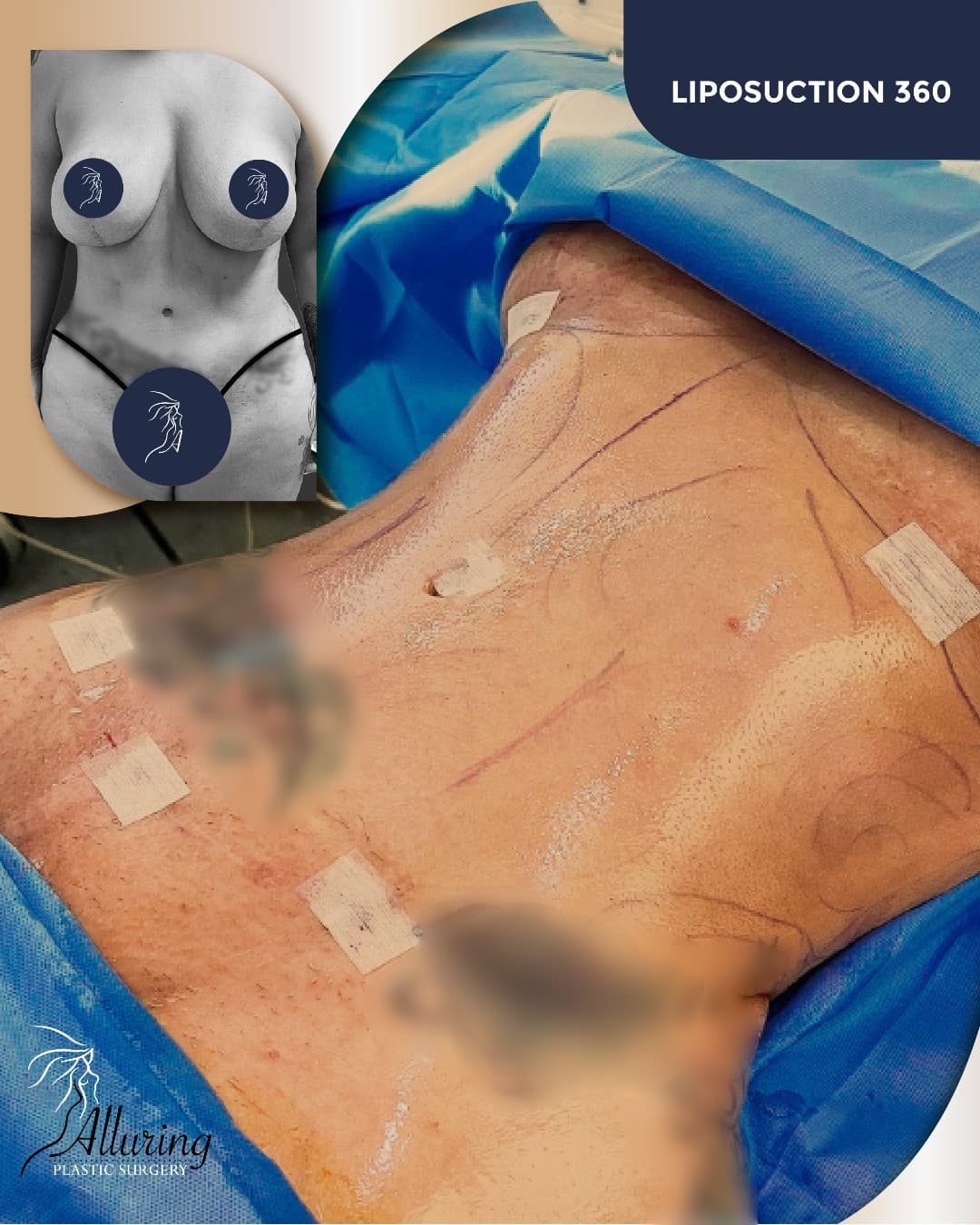 ✨ Your Dream Waistline Awaits! ✨
Dr. Karlinsky’s expert touch delivers stunning, natural-looking res