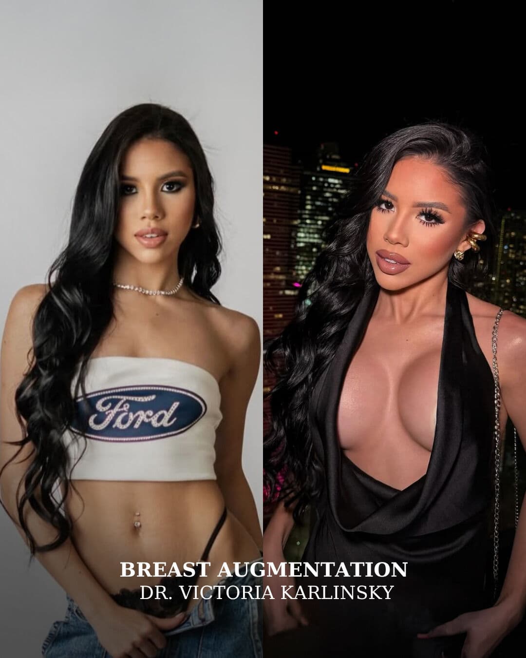 It was good before, we just made help to make it better🍒
Breast Aug by Dr. Karlinsky of course✅ ❤
