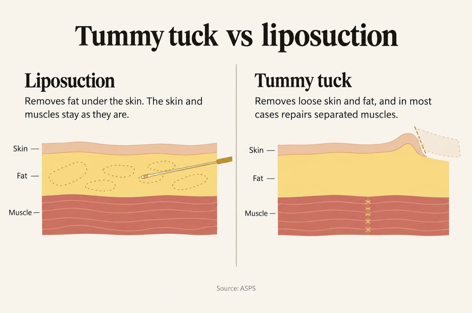 Stylised side-by-side illustration of the abdominal wall in cross-section. Left, labeled Liposuction: removes fat under the skin; the skin and muscles stay as they are. Right, labeled Tummy tuck: removes loose skin and fat, and in most cases repairs separated muscles. Source: ASPS.